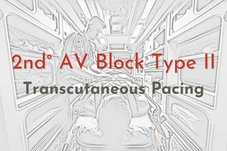 Transcutaneous Pacing - Second Degree AV Block Type II